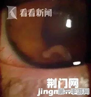 男子眼球惊现4条活虫！疑因苍蝇入侵👀😱